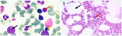 Non-hepatitis-associated mixed cryoglobulinemia with polyclonal plasma cells disease and alcoholic cirrhosis: A rare case report